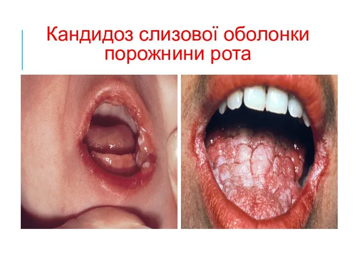 Кандидоз слизової оболонки порожнини рота