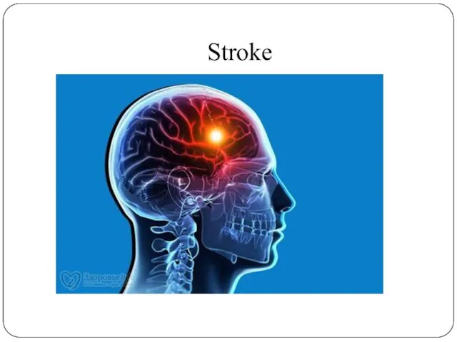 Stroke