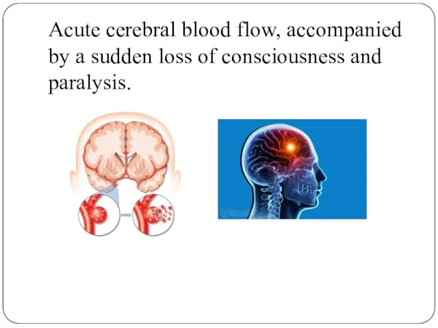 Acute cerebral blood flow, accompanied by a sudden loss of consciousness and paralysis.