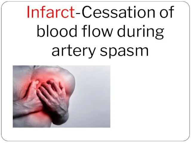 Infarct-Cessation of blood flow during artery spasm