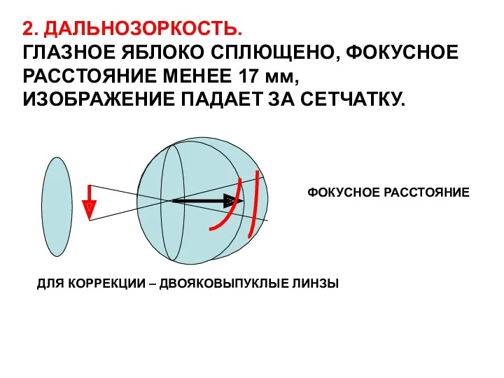 2. ДАЛЬНОЗОРКОСТЬ. ГЛАЗНОЕ ЯБЛОКО СПЛЮЩЕНО, ФОКУСНОЕ РАССТОЯНИЕ МЕНЕЕ 17 мм, ИЗОБРАЖЕНИЕ ПАДАЕТ ЗА