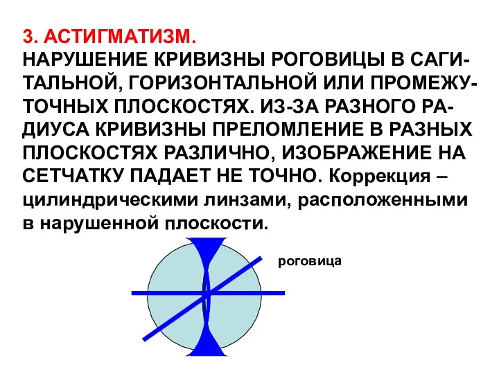 3. АСТИГМАТИЗМ. НАРУШЕНИЕ КРИВИЗНЫ РОГОВИЦЫ В САГИ- ТАЛЬНОЙ, ГОРИЗОНТАЛЬНОЙ ИЛИ ПРОМЕЖУ- ТОЧНЫХ ПЛОСКОСТЯХ.