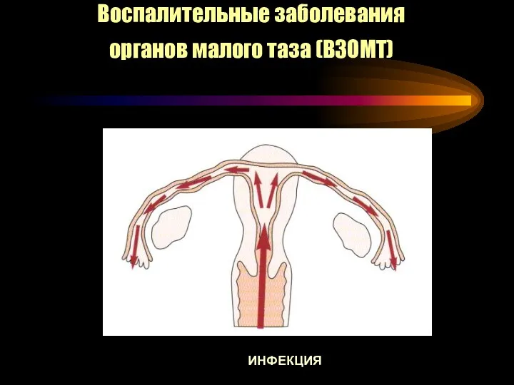 ИНФЕКЦИЯ Воспалительные заболевания органов малого таза (ВЗОМТ)