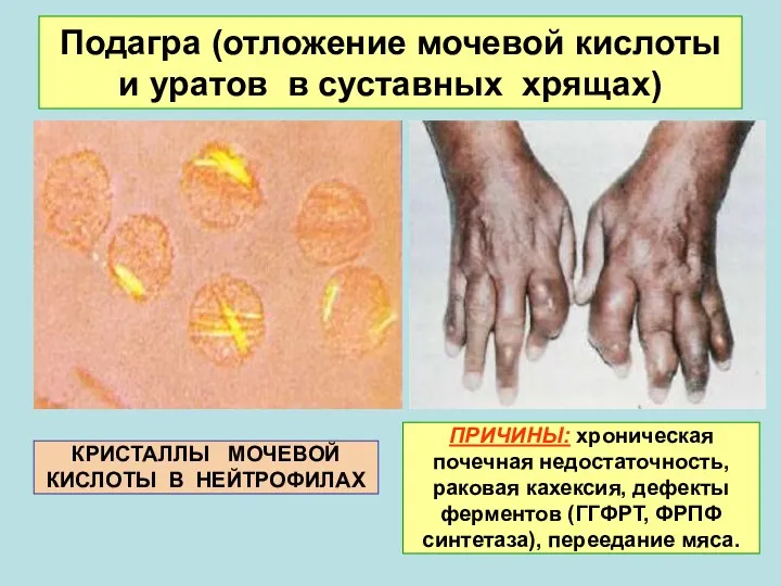 Подагра (отложение мочевой кислоты и уратов в суставных хрящах) КРИСТАЛЛЫ