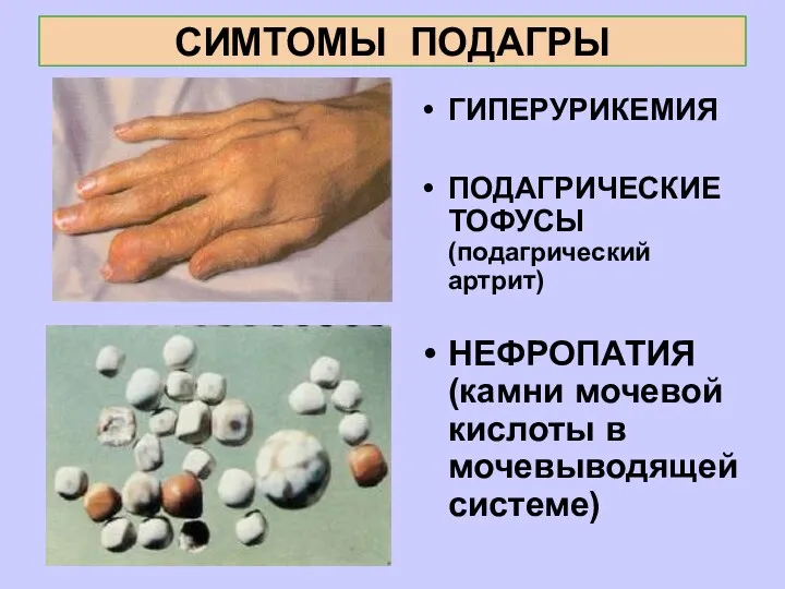 СИМТОМЫ ПОДАГРЫ ГИПЕРУРИКЕМИЯ ПОДАГРИЧЕСКИЕ ТОФУСЫ (подагрический артрит) НЕФРОПАТИЯ (камни мочевой кислоты в мочевыводящей системе)