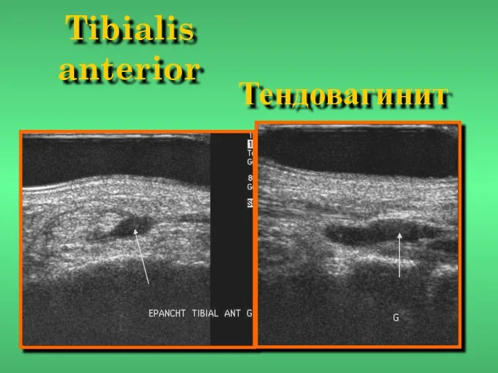 Tibialis anterior Тендовагинит
