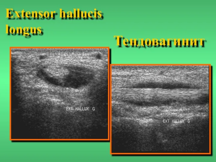 Тендовагинит Extensor hallucis longus