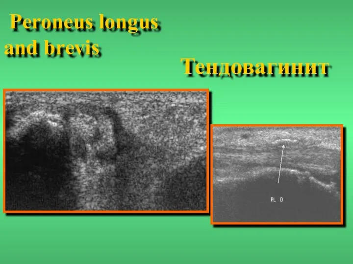 Тендовагинит Peroneus longus and brevis