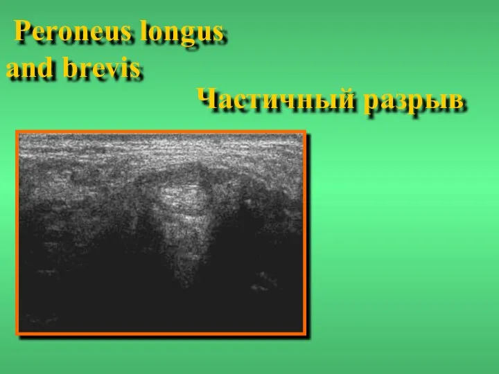 Частичный разрыв Peroneus longus and brevis