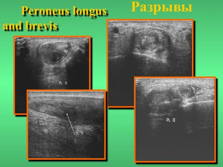 Peroneus longus and brevis Разрывы