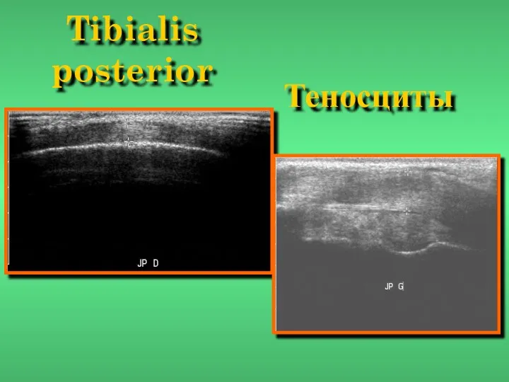 Tibialis posterior Теносциты