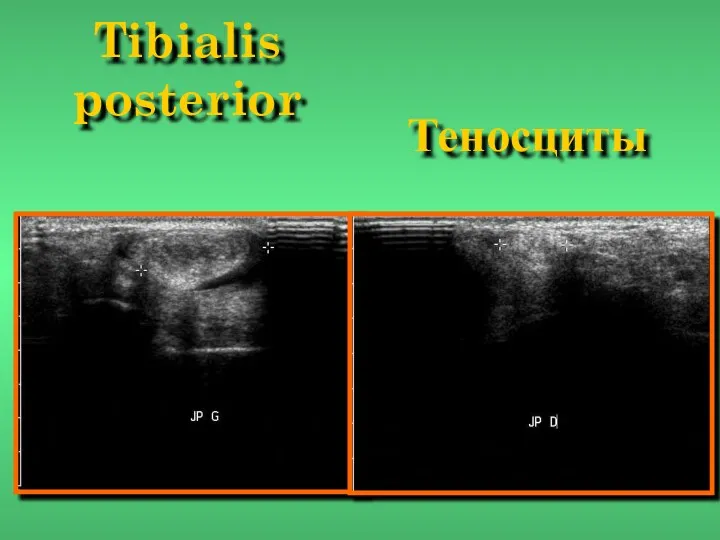 Tibialis posterior Теносциты