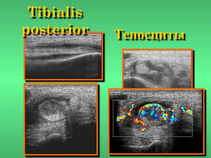 Tibialis posterior Теносциты