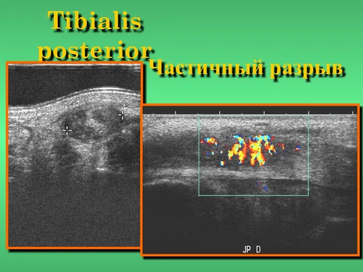 Tibialis posterior Частичный разрыв