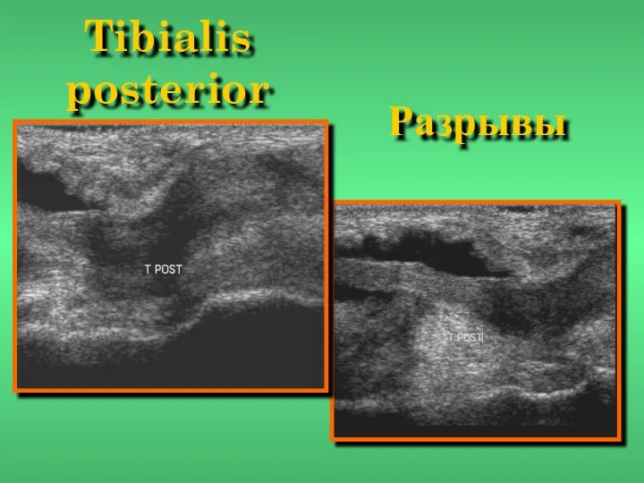 Tibialis posterior Разрывы
