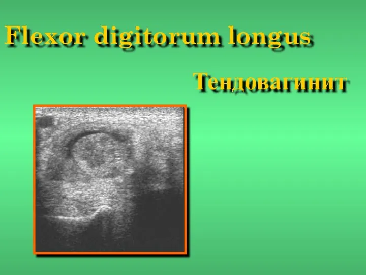 Flexor digitorum longus Тендовагинит