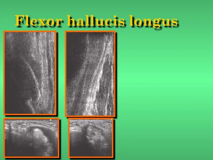 Flexor hallucis longus