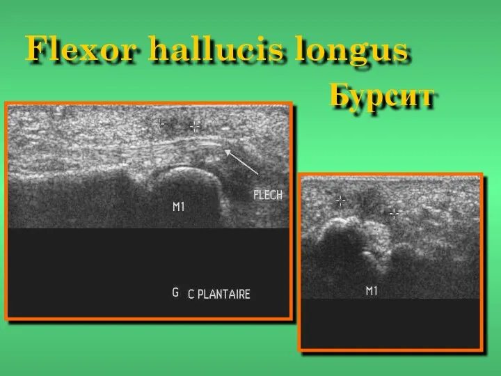 Flexor hallucis longus Бурсит