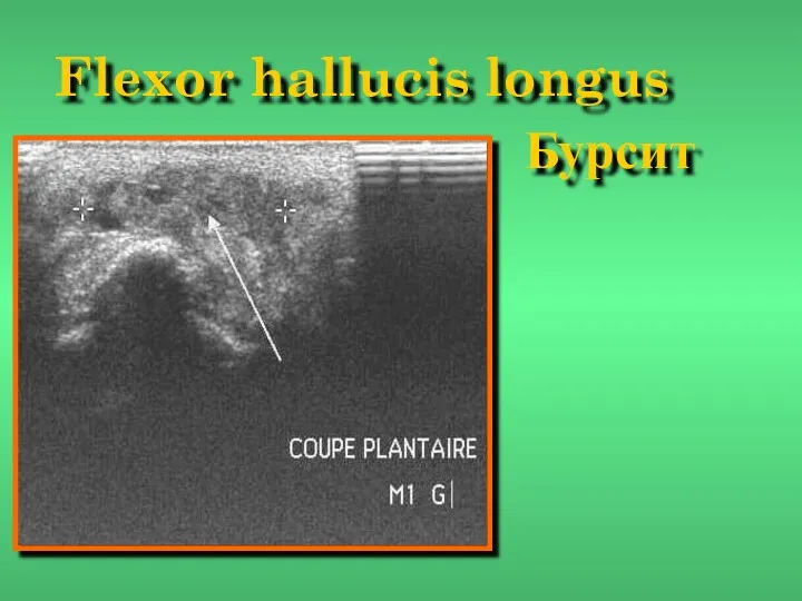 Flexor hallucis longus Бурсит