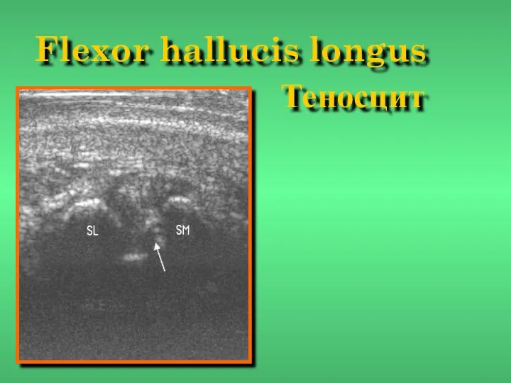 Flexor hallucis longus Теносцит