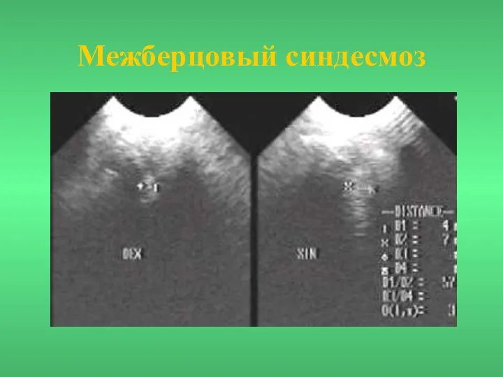 Межберцовый синдесмоз