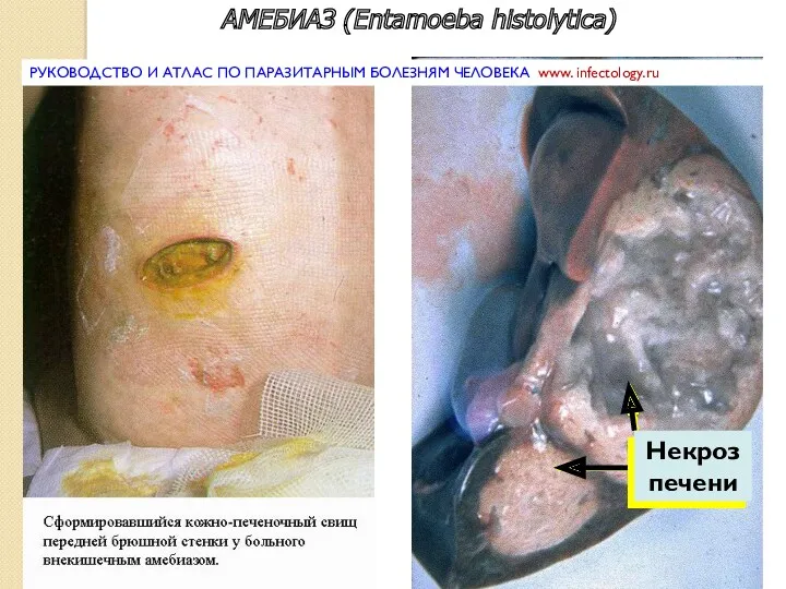 АМЕБИАЗ (Entamoeba histolytica) Некроз печени РУКОВОДСТВО И АТЛАС ПО ПАРАЗИТАРНЫМ БОЛЕЗНЯМ ЧЕЛОВЕКА www. infectology.ru