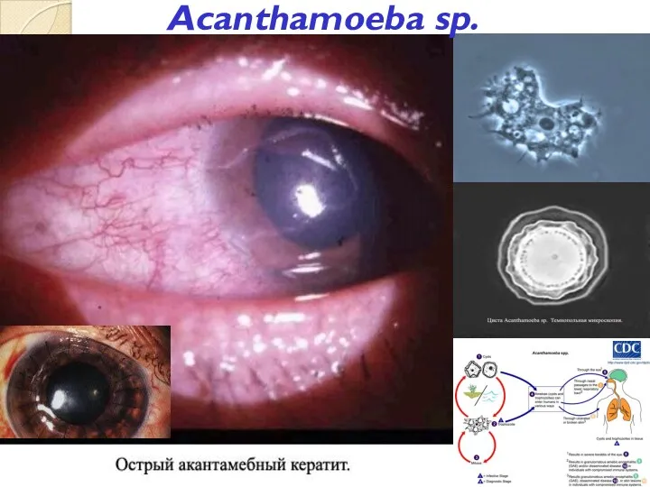 Acanthamoeba sp.