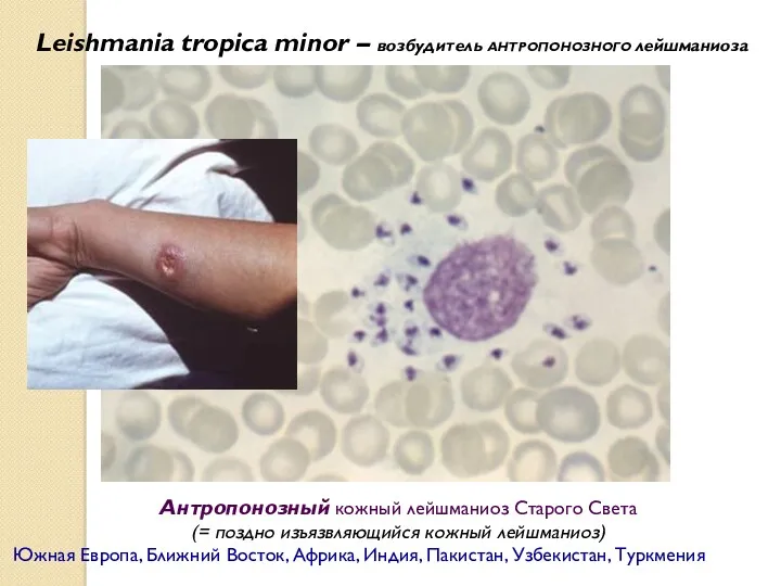 Leishmania tropica minor – возбудитель АНТРОПОНОЗНОГО лейшманиоза Антропонозный кожный лейшманиоз
