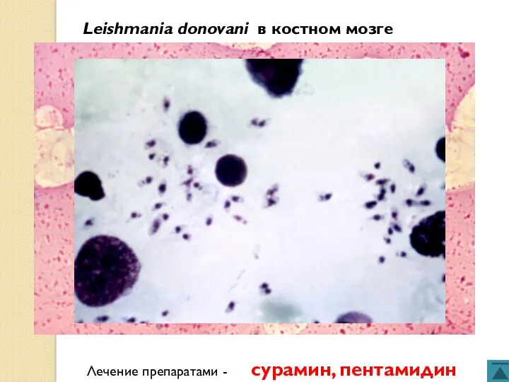 Leishmania donovani в костном мозге Лечение препаратами - сурамин, пентамидин