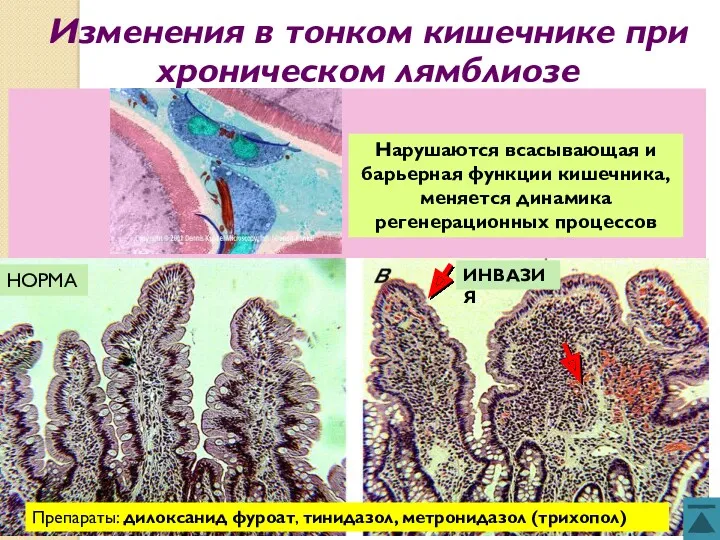 Изменения в тонком кишечнике при хроническом лямблиозе ИНВАЗИЯ Нарушаются всасывающая