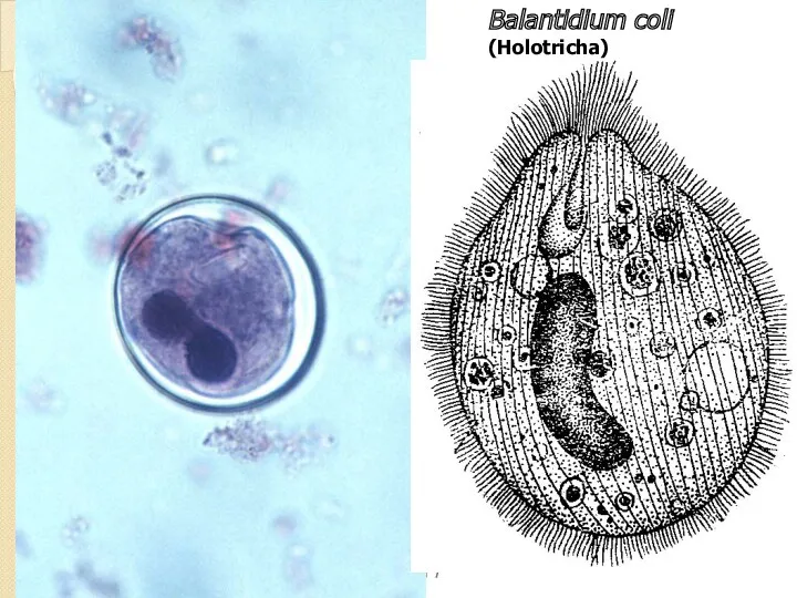Balantidium coli (Holotricha) БАЛАНТИДИАЗ симптомы: общая интоксикация, язвенные поражения толстой кишки, изнурительный понос и истощение