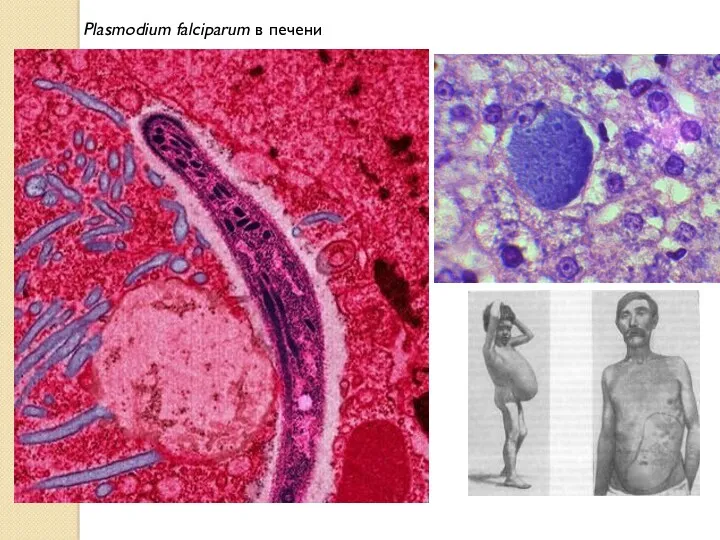 Plasmodium falciparum в печени