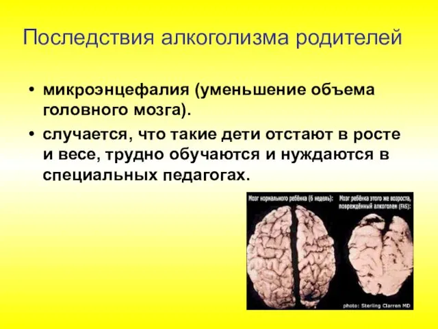 микроэнцефалия (уменьшение объема головного мозга). случается, что такие дети отстают