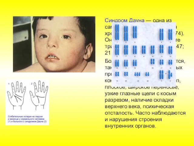 Синдром Дауна — одна из самых часто встречающихся хромосомных болезней