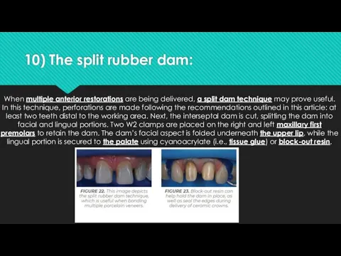 10) The split rubber dam: When multiple anterior restorations are