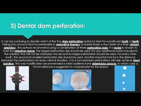 3) Dental dam perforation: It can be confusing to decide