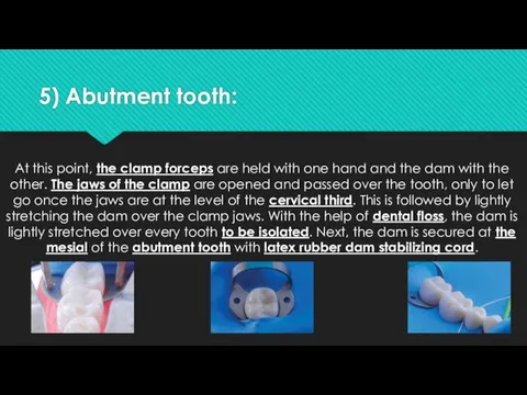 5) Abutment tooth: At this point, the clamp forceps are