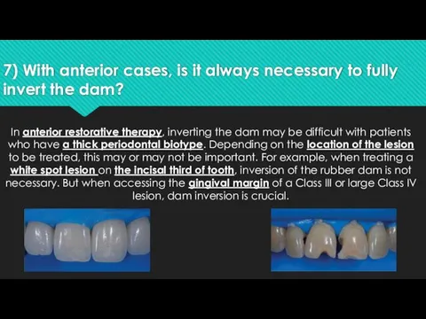 7) With anterior cases, is it always necessary to fully