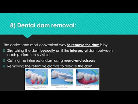 8) Dental dam removal: The easiest and most convenient way