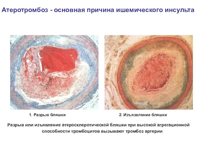 Атеротромбоз - основная причина ишемического инсульта Разрыв или изъявление атеросклеротической