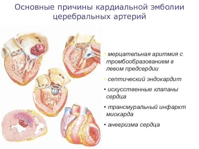 Основные причины кардиальной эмболии церебральных артерий мерцательная аритмия с тромбообразованием