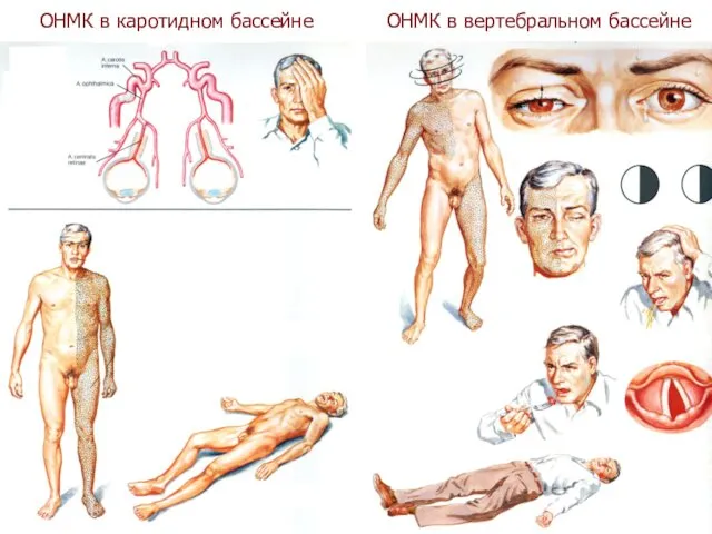 ОНМК в каротидном бассейне ОНМК в вертебральном бассейне