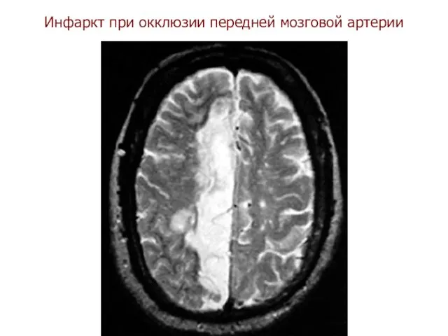Инфаркт при окклюзии передней мозговой артерии