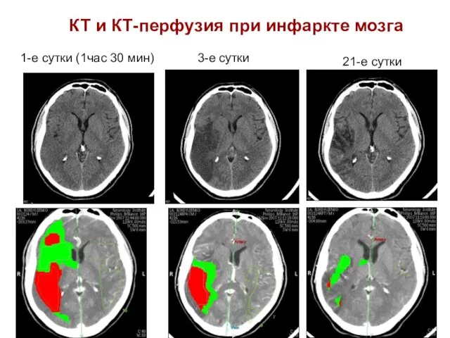 КТ и КТ-перфузия при инфаркте мозга 1-е сутки (1час 30 мин) 3-е сутки 21-е сутки