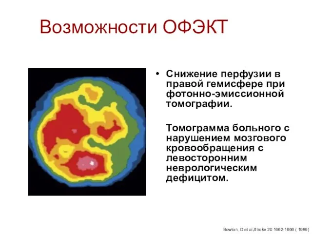 Возможности ОФЭКТ Снижение перфузии в правой гемисфере при фотонно-эмиссионной томографии.