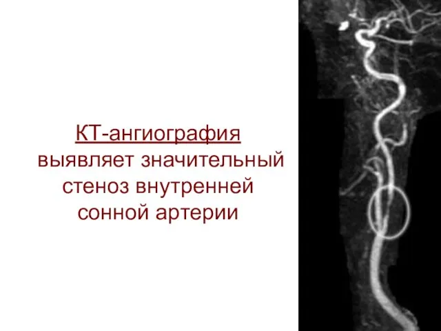 КТ-ангиография выявляет значительный стеноз внутренней сонной артерии