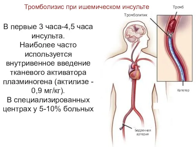 В первые 3 часа-4,5 часа инсульта. Наиболее часто используется внутривенное