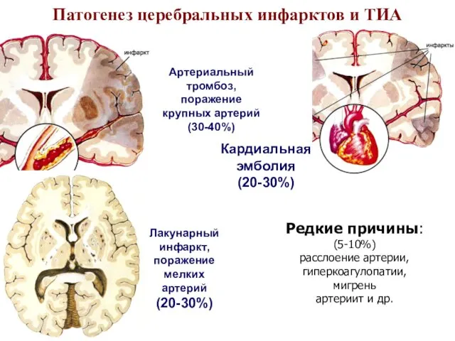 Патогенез церебральных инфарктов и ТИА Кардиальная эмболия (20-30%) Артериальный тромбоз,