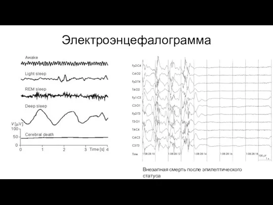 Электроэнцефалограмма Внезапная смерть после эпилептического статуса