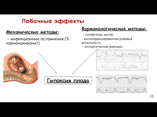 Побочные эффекты Механические методы: - инфекционные осложнения (% хорионамнионит) Фармакологические